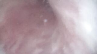 Endoscope inner emissions from ejaculatory duct