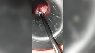 Anal inspection with endoscope camera